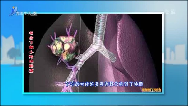 带你了解小细胞肺癌