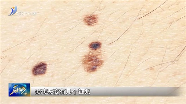 这些部位的黑痣 警惕有癌变风险 【威海广电讯】