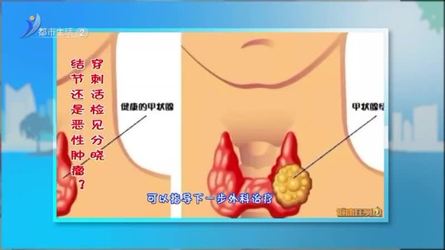 结节还是恶性肿瘤？穿刺活检见分晓 【威海广电讯】