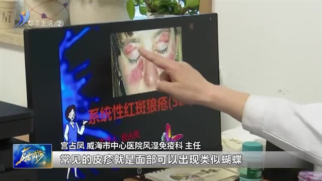 皮肤出现红斑不一定是皮疹，有可能是红斑狼疮！【威海广电讯】