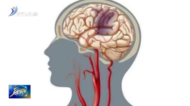 头晕、乏力、恶心 小心是颈动脉狭窄【威海广电讯】