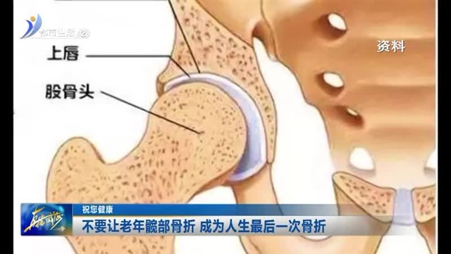 不要让老年髋部骨折 成为人生最后一次骨折【威海广电讯】