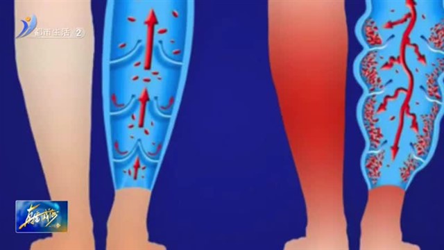 放血治静脉曲张？偏方治疗需谨慎！【威海广电讯】