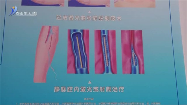 静脉曲张不想留疤？激光微创治疗试过吗【威海广电讯】