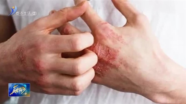 手部湿疹为何青睐中年女性？【威海广电讯】