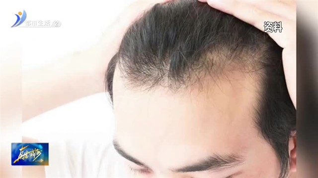 挽救“头顶大事” 植发不得不说的那些事【威海广电讯】