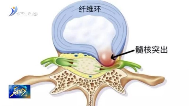 椎间盘突出症不想手术？试试中医保守治疗【威海广电讯】
