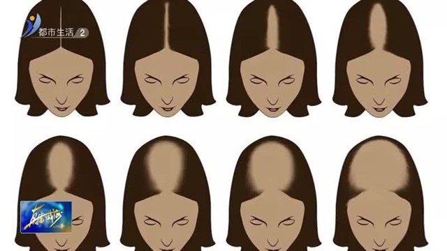 你脱发吗？脱发真的不可治愈吗？【威海广电讯】