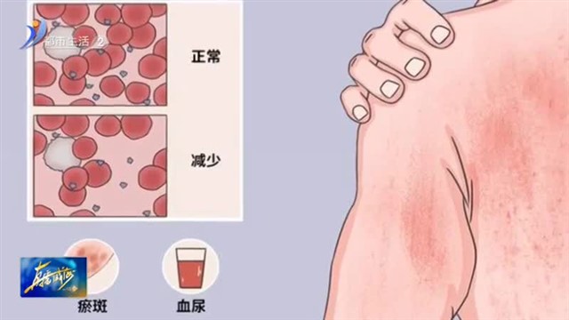 家长注意！孩子这些症状可能是血小板减少症【威海广电讯】